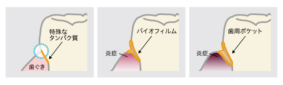 歯周病に感染するまでのメカニズム